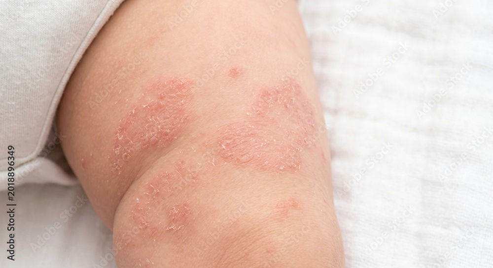 Naklejka premium Close up of baby thigh with red scaly eczema patches