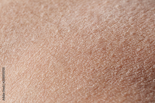 Fotografie Man with dry skin on black background, closeup