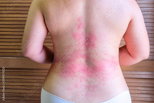 Back flare-up rashes due to autoimmune disease