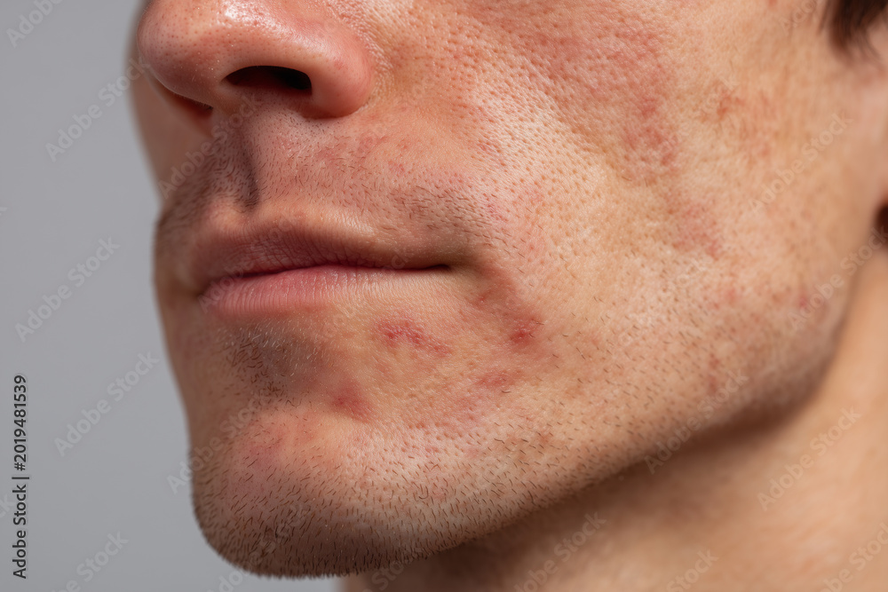 Naklejka premium Facial Allergic Rash