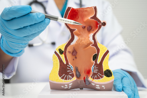 Slika na platnu Asian doctor with rectum and hemorrhoid human model, inflamed vascular structure