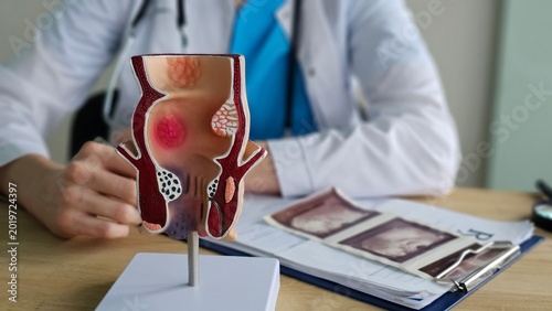Fotografía Proctologist with a model of human rectal anatomy and hemorrhoids in a hospital,