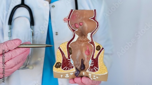 Slika na platnu Proctologist with a model of human rectal anatomy and hemorrhoids in a hospital,