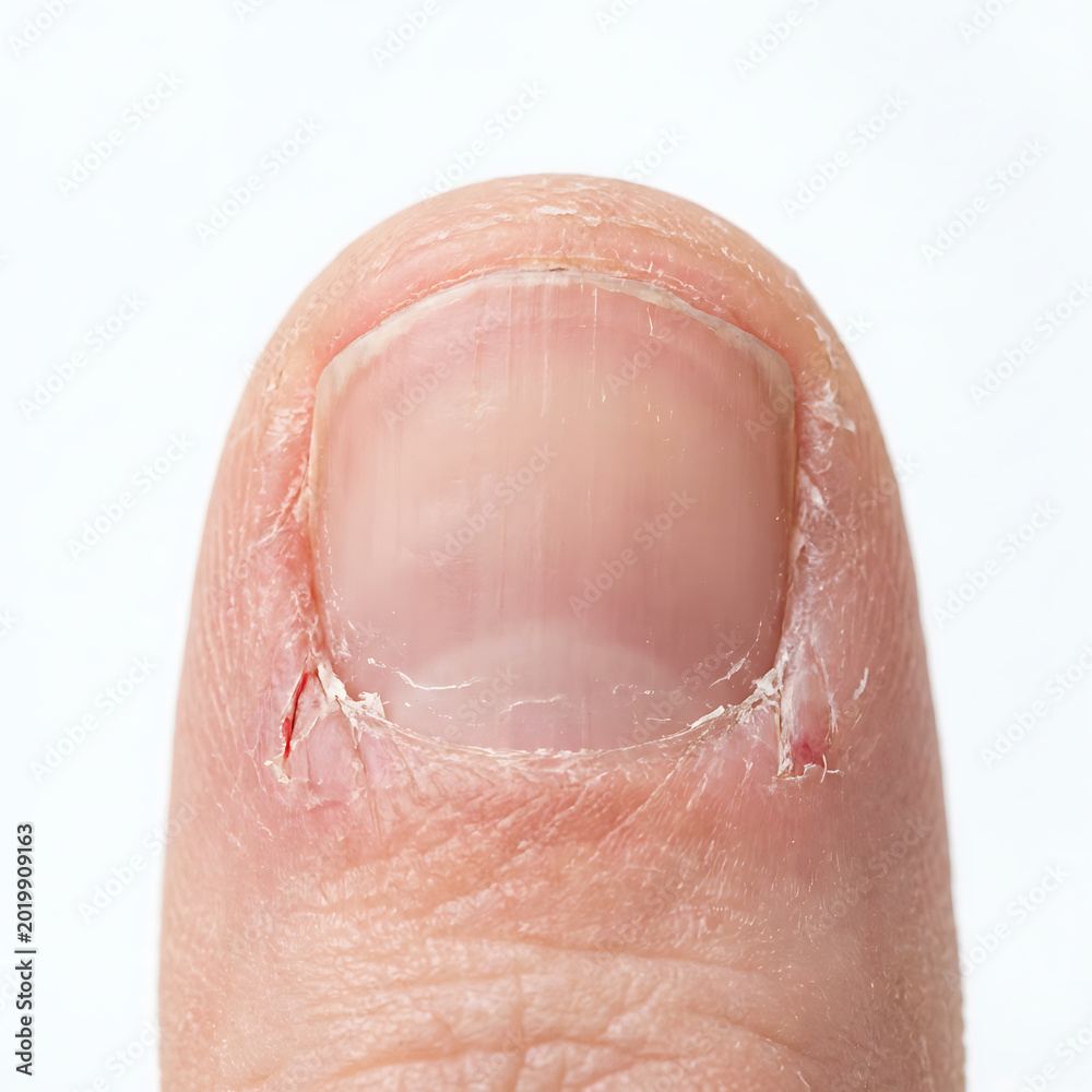 Fototapeta premium Close-up of human thumb with damaged nail and dry skin 