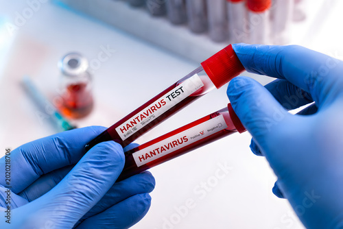 Close up of a healthcare professional's hands in blue gloves holding two blood sample tubes labeled 'hantavirus test' in a medical laboratory setting with blurred equipment