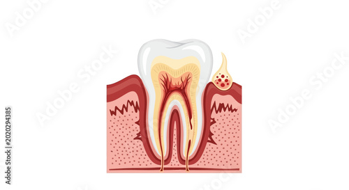 Anatomy of a tooth with abscess.