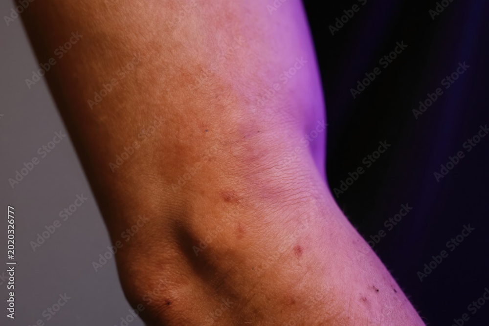 Fototapeta premium Muscular male arm shows minor skin abrasions and bruising near elbow joint. Dark background with purple and orange lighting suggests medical or fitness context. Injury or skin condition visible.