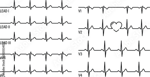 Schilderij op canvas Electrocardiogram E C G printout on grid paper in standard leads and precordial