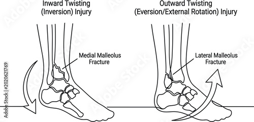 Tableau sur toile Ankle Fracture Medical Illustration Showing Inversion and Eversion Twisting Inju