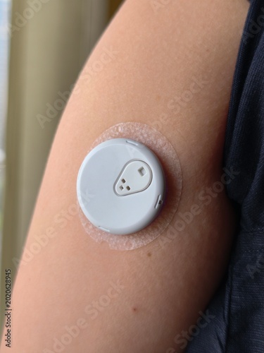 Continuous glucose monitor sensor attached to patient arm for health
