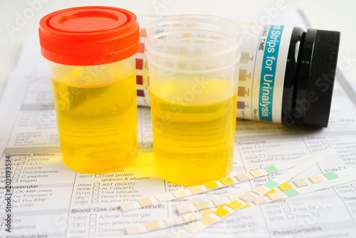 Fotografía Urinalysis, urine cup for check health examination in laboratory.