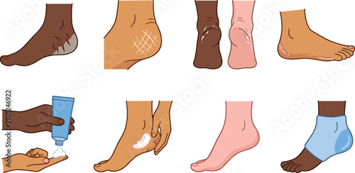 Photos Dry Cracked Feet Treatment Collection with Heel Care, Moisturizing, and Foot Pro