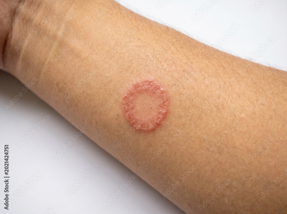 Fototapeta premium Close-up of ringworm tinea corporis on arm showing circular red scaly fungal lesion ring shaped rash, dermatology skin infection concept
