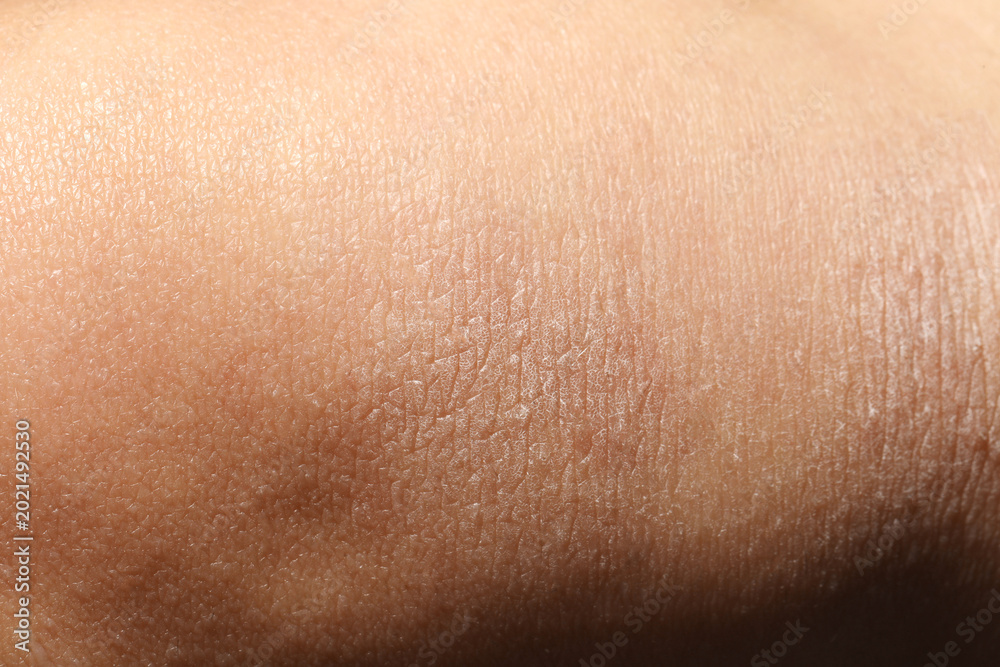 Fototapeta premium Texture of dry skin as background, closeup