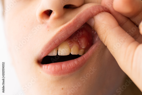 Fotografia Child showing inflamed gum and tooth pain