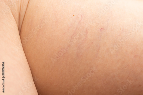 Skin with spider veins on woman leg. Vascular condition and capillary visibility on human body. Medical dermatological examination and skin health concept for healthcare treatment.