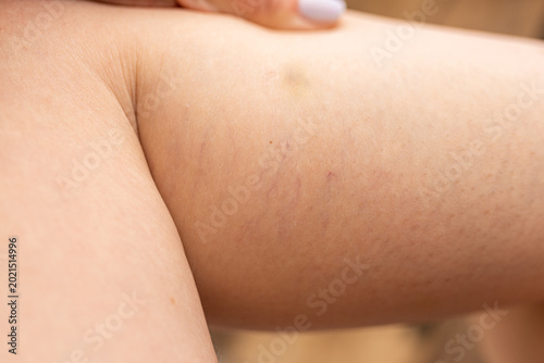 Woman leg showing spider vein and bruise on skin. Vascular problem and medical condition. Dermatological issue, dermatology checkup, aesthetic defect on female leg skin for health care.