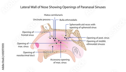 Foto Lateral Wall of Nose Showing Openings of Paranasal Sinuses
lateral nasal wall with turbinates removed showing drainage openings of paranasal sinuses