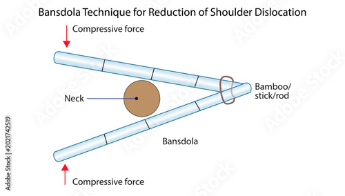 Foto Bansdola Technique for Reduction of Shoulder Dislocation
Orthopedic illustration demonstrating the Bansdola method using compressive force and a rod for shoulder dislocation reduction
