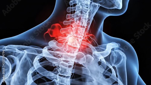 3D medical render of human anatomy with red glowing neck pain on black background