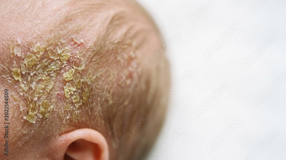 Naklejka premium Close-up of an infant's scalp showing yellow flaky skin patches and dry crusty scales on the head