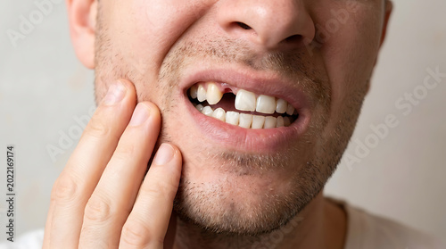 Man showing a missing front tooth and touching his cheek due to dental pain or injury