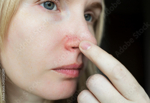 Close-up of a woman's nose with couperose and rosacea, visible dilated capillaries and vascular network. Skin redness and telangiectasia needing dermatological treatment or laser removal.