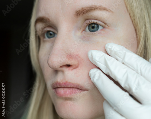 Foto Close-up of woman with couperose and rosacea on nose, dermatologist in gloves examining red vascular mesh and dilated capillaries