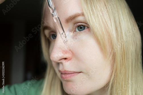 Slika na platnu Close-up of woman applying serum with pipette on face with couperose and rosacea symptoms on nose