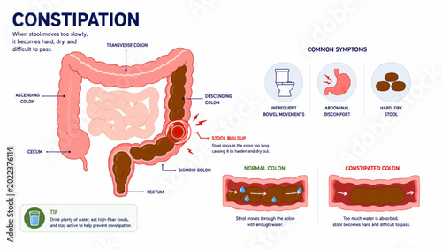 Konstfotografi Constipation Digestive System and Colon Medical Infographic