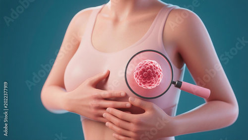 Uterine fibroids are common benign gynecological tumors growing on the uterine wall, closely associated with hormonal changes and female physiological health. They may cause menstrual irregularities, 