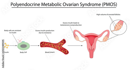 Foto Polyendocrine Metabolic Ovarian Syndrome (PMOS) vector illustration