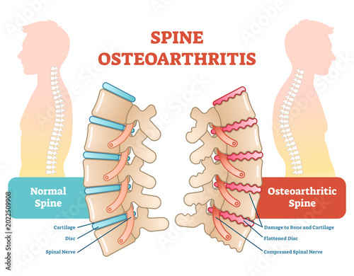 Canvas Print Spine osteoarthritis anatomical illustration diagram, educational medical scheme information, transparent background