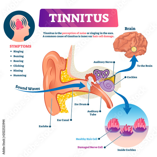 Obraz na płótnie Tinnitus illustration, transparent background