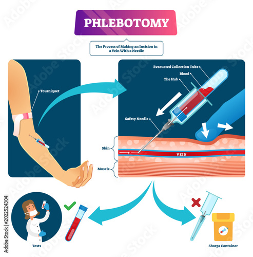 Konstfotografi Phlebotomy illustration, transparent background