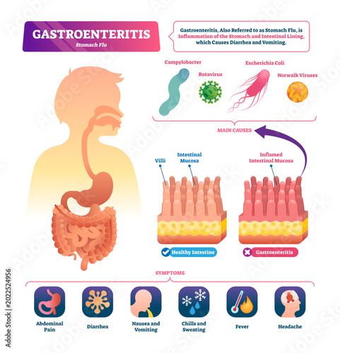Bild auf Leinwand Gastroenteritis illustration, transparent background
