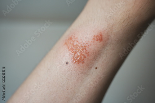 腕の裂傷から膿が出る