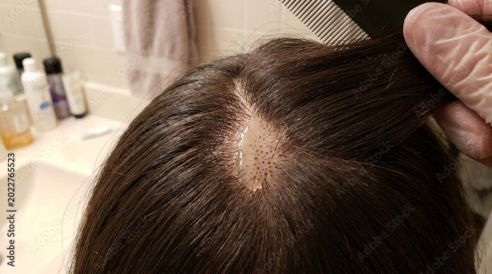 Fototapeta premium Applying clear serum treatment to scalp bald spot