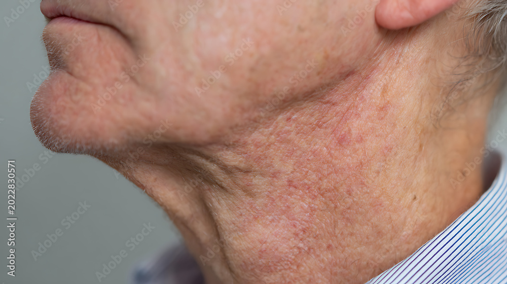 Naklejka premium Close-up of an older person's neck and jawline, showing aged skin texture and signs of sun damage or irritation in a medical context