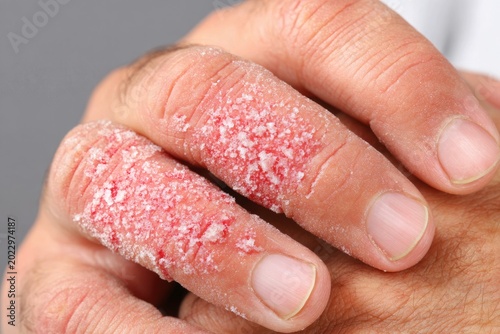 Close-Up of Hands Showing Dry Skin and Irritation from Winter Weather