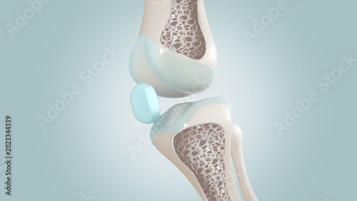 Fotografie Osteoporosis, knee maintenance, and prevention of bone degeneration