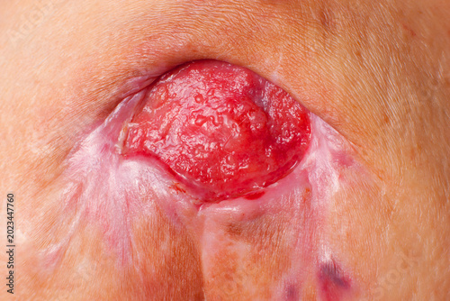 Fotografia Close-up medical image of a severe stage 4 pressure ulcer (bedsore, decubitus ulcer) with granulation tissue and signs of chronic inflammation