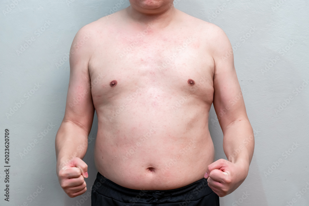 Naklejka premium The symptom of Dengue fever on skin of a man 39 years old, the detail of red spots and rash on the skin of a man in the recovery phase.