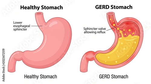 Healthy vs gerd stomach illustration with esophageal sphincter detail