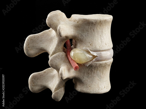 Lumbar spine segment with herniated disc compressing a nerve, a detailed anatomical 3D rendering of a spinal pathology isolated on a black background.