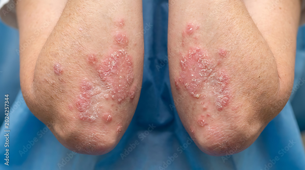Fototapeta premium Close-up of Elbows affected by Psoriasis, a chronic skin condition, with red, scaly patches