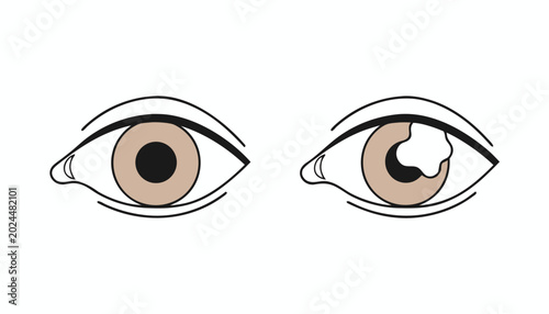 Fotografie Comparison of healthy human eye with a cataract-affected eye showing cloudy lens condition