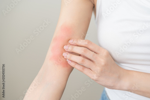 Φωτογραφία Dermatology asian young woman allergy, allergic reaction from atopic, insect bite, scratching itchy back of hand, red spot or rash of skin