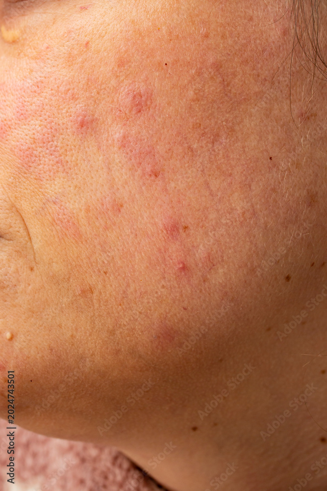 Fototapeta premium Red rash eczema on a woman face due to liver disease , close up texture