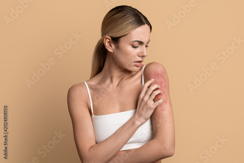 Obraz na plátně Young woman scratching her red irritated arm skin with worried look while standing on beige studio background